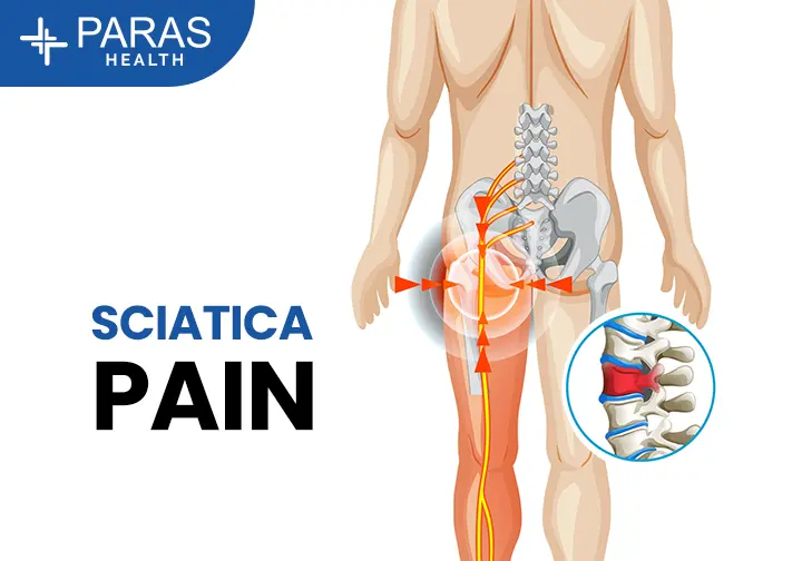 Sciatica pain